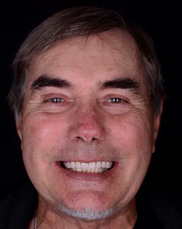 After the Dental Procedure