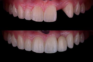 Dental Bridges