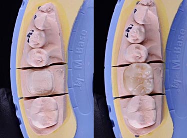 Dental Crowns