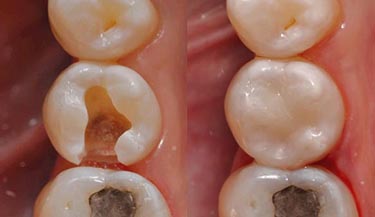 Tooth Fillings